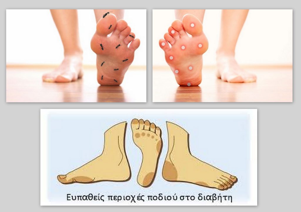 ΔΙΑΒΗΤΙΚΟ ΠΟΔΙ ΔΙΑΒΗΤΙΚΟ ΠΟΔΙ